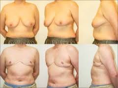 before and after images of top surgery (not me)